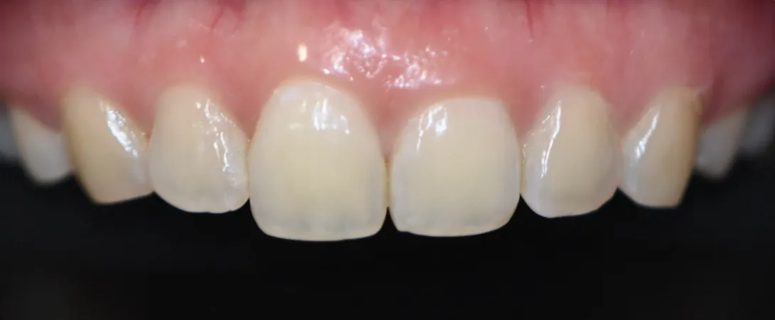 After: brighter, even front teeth with DIAlami veneers