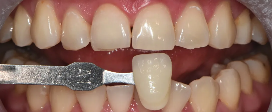 After: teeth matched to VITA shade A1