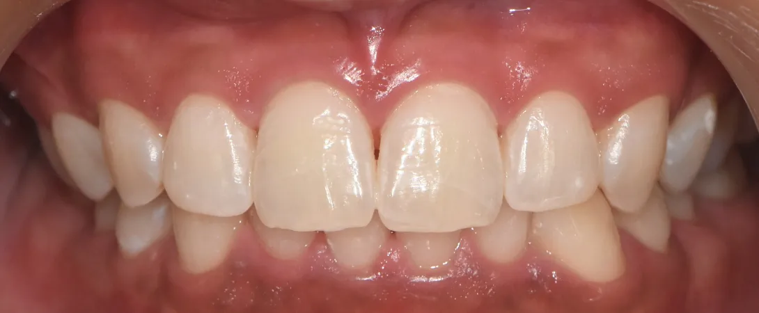 After: gaps closed with DIAlami veneers
