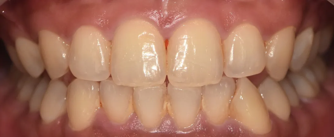 Before: gaps between front teeth